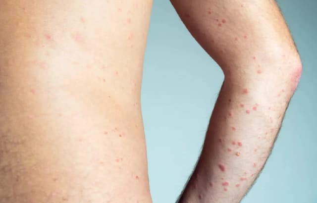 Корь не сдается в Малаге: 39 случаев с начала года