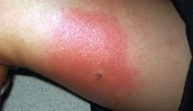 Не осы и не комары: самые опасные укусы лета